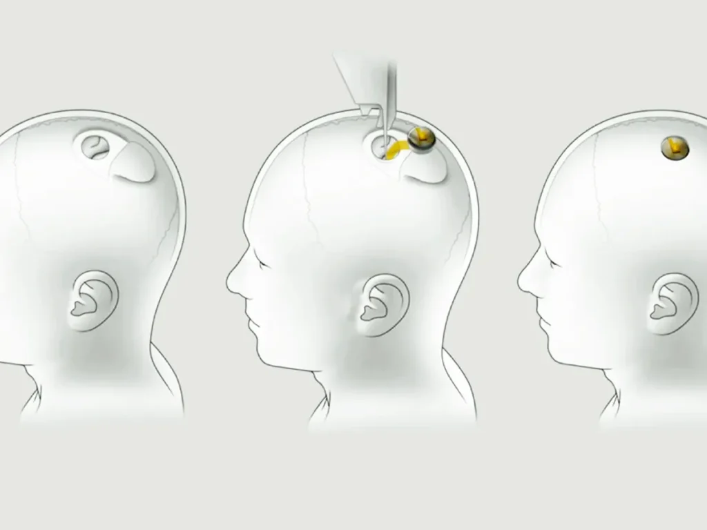 how does neuralink work?