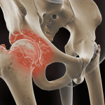 3D anatomical illustration of a human pelvis and hip joint, highlighting inflammation and pain in the socket area, showing signs of Hip Arthritis Without Surgery treatment focus.