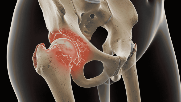3D anatomical illustration of a human pelvis and hip joint, highlighting inflammation and pain in the socket area, showing signs of Hip Arthritis Without Surgery treatment focus.