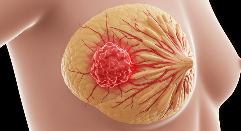 Breast Cancer: Causes, Early Detection, and Treatment Guide 1 3D illustration of a human breast showing adipose tissue and a prominent red tumor, symbolizing breast cancer.